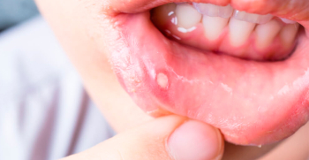 Úlceras bucales: causas, síntomas, prevención y tratamiento