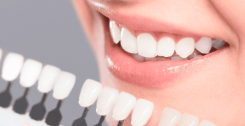 Carillas dentales de porcelana: la opción Ideal para una sonrisa radiante