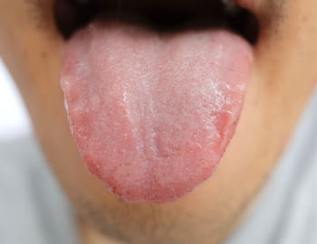 Tens la boca seca més sovint del normal?