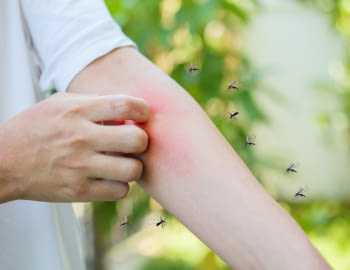 Picades de mosquit: com alleujar la picor i cuidar la pell
